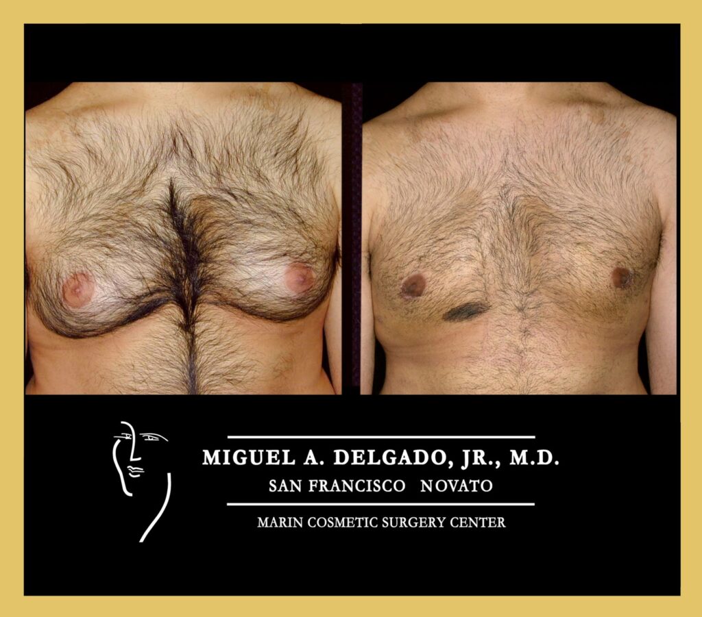 Gynecomastia is female-like breast on a man