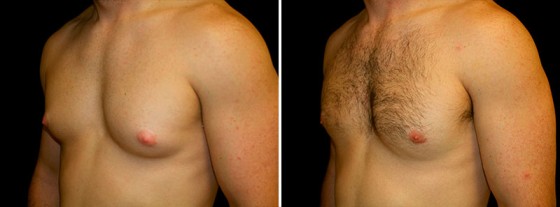 gynecomastia