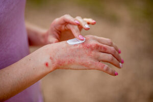 Relieve Eczema